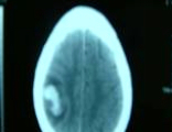 鼻咽癌的手術(shù)療法